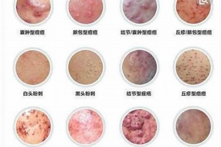 梦见自己得性病下体长痘痘的预兆