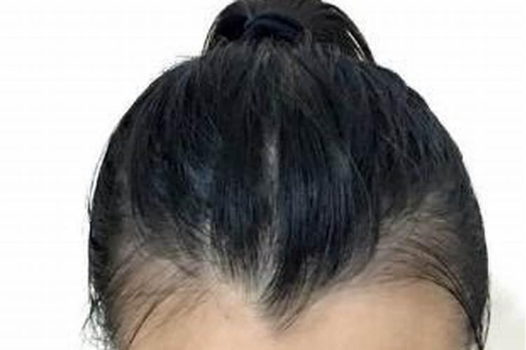 美人尖剃了影响运势吗,美人尖刮掉会怎样