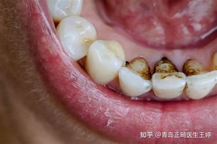 梦到牙齿碎掉了吐出来一片片碎牙.还有牙结石