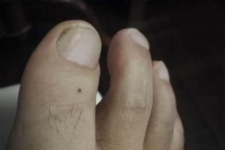 脚底有痣是什么命运 脚底有痣需要去掉吗？