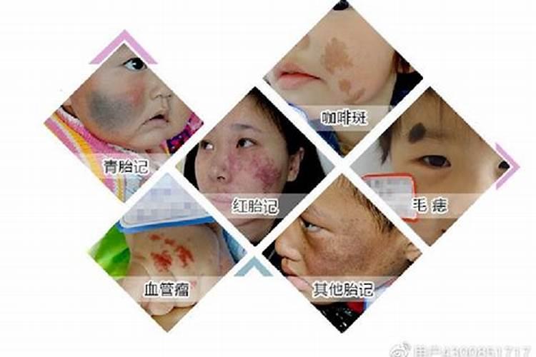 真童子胎记位置与命理解析