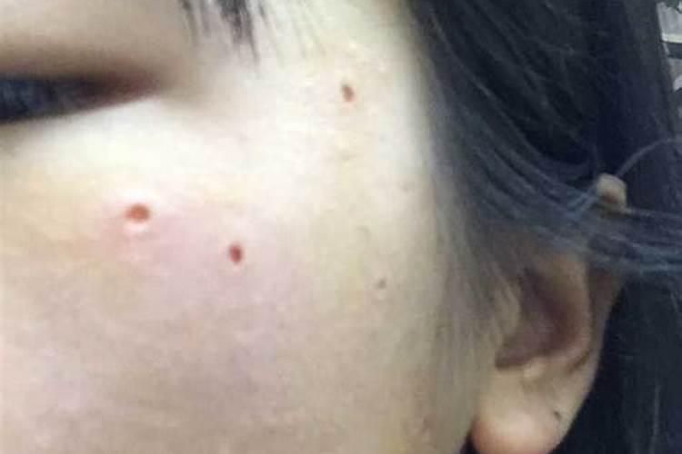 额头上长的痣好不好 额头有痣的人命运如何