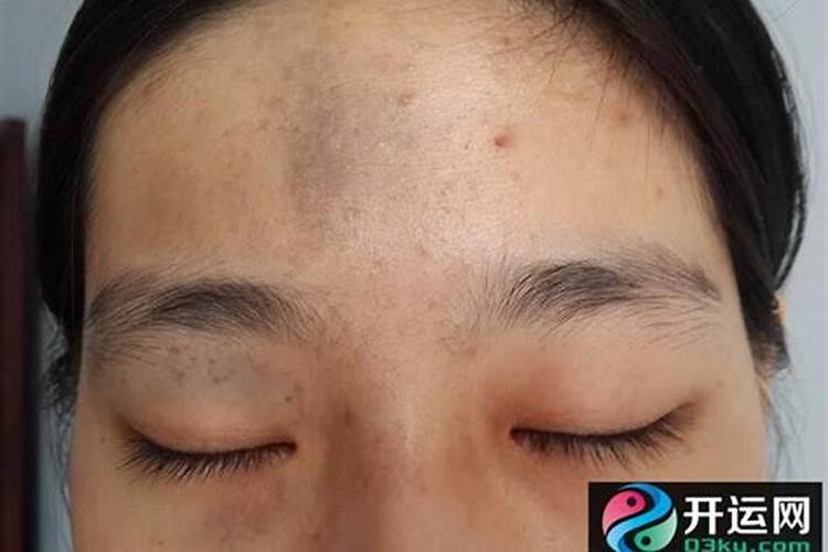 印堂有痣代表什么 婚姻运好不好